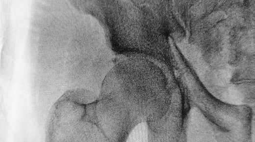 xray of femoral neck